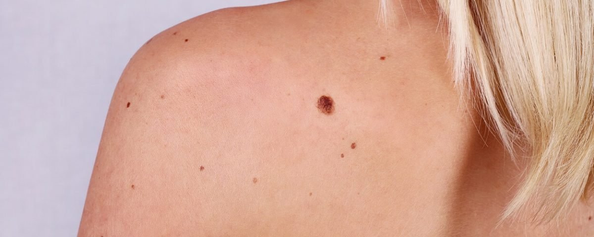 Você Observa Seus Sinais? | Clinica Pele Saudável